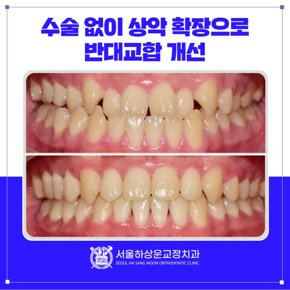 분당 교정치과 수술없이 상악 확장으로 반대교합 개선
